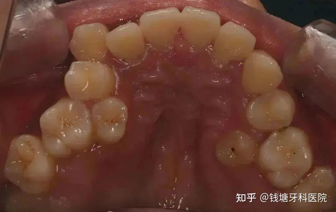 发现即矫正,7岁是儿童正畸的第一个黄金期! - 知乎
