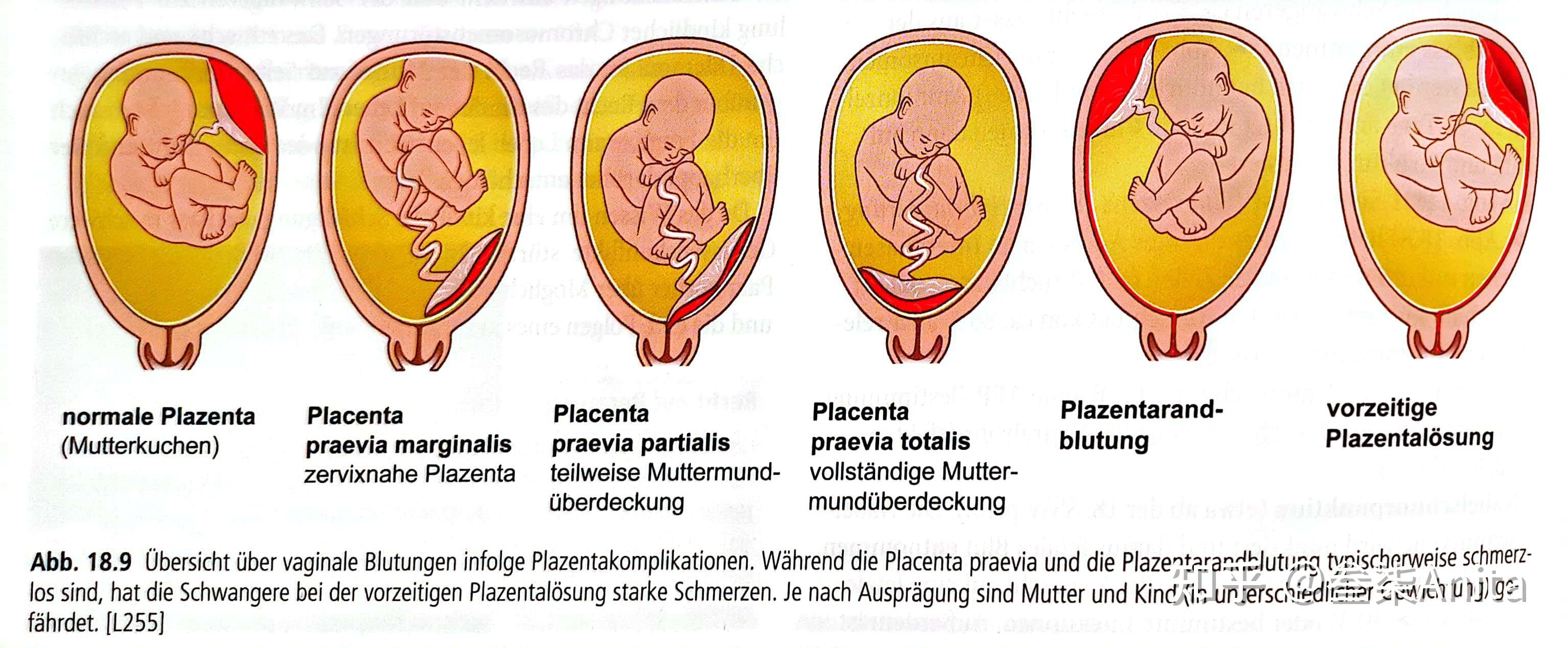 怀孕与生产系统重点疾病护理德语笔记