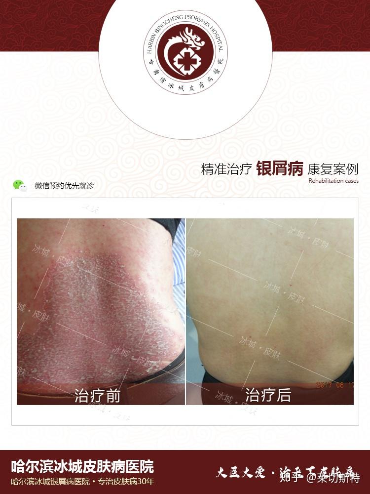 各种皮肤癣的图片大全症状