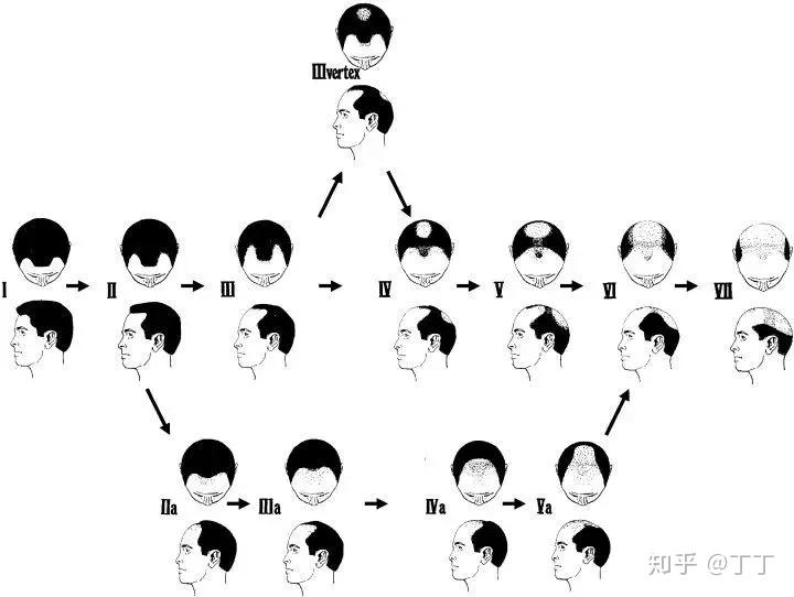 为啥头秃的总是男人？男人秃顶、脱发怎么办？雄激素性秃发的规范诊疗。 - 知乎