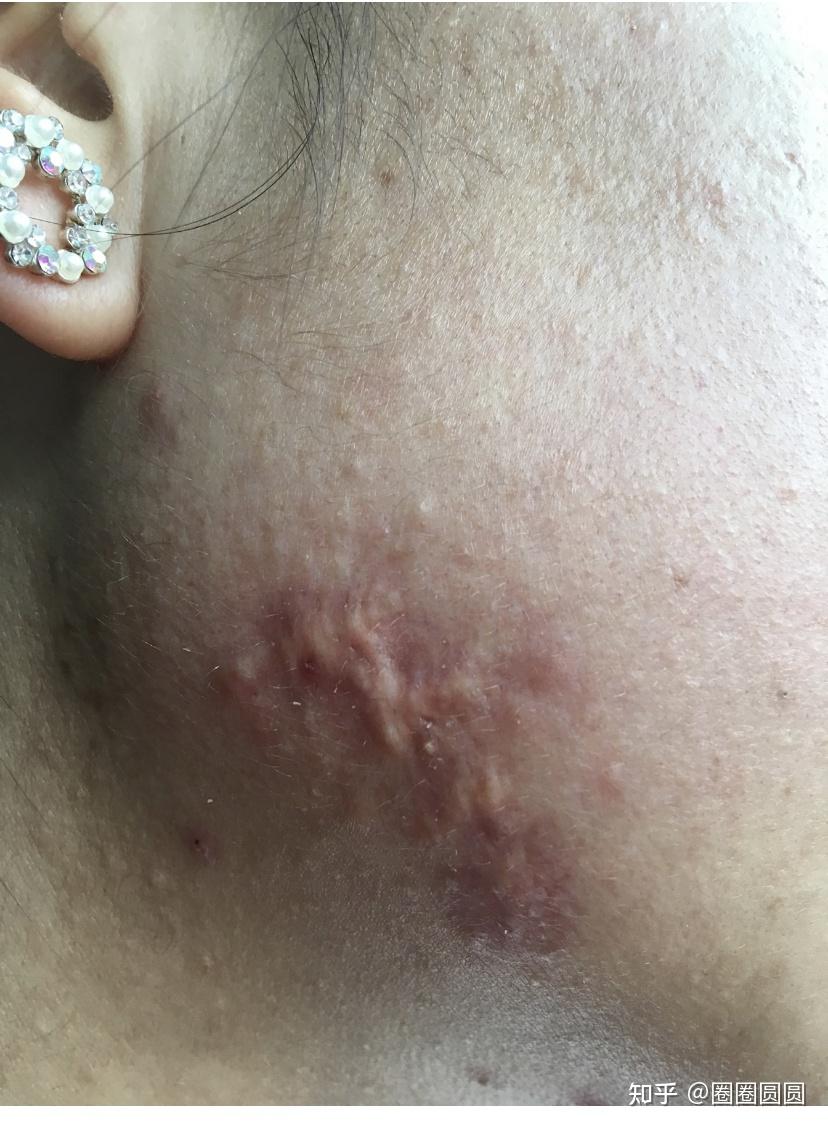 记录我跟疤痕增生一起战斗的日子