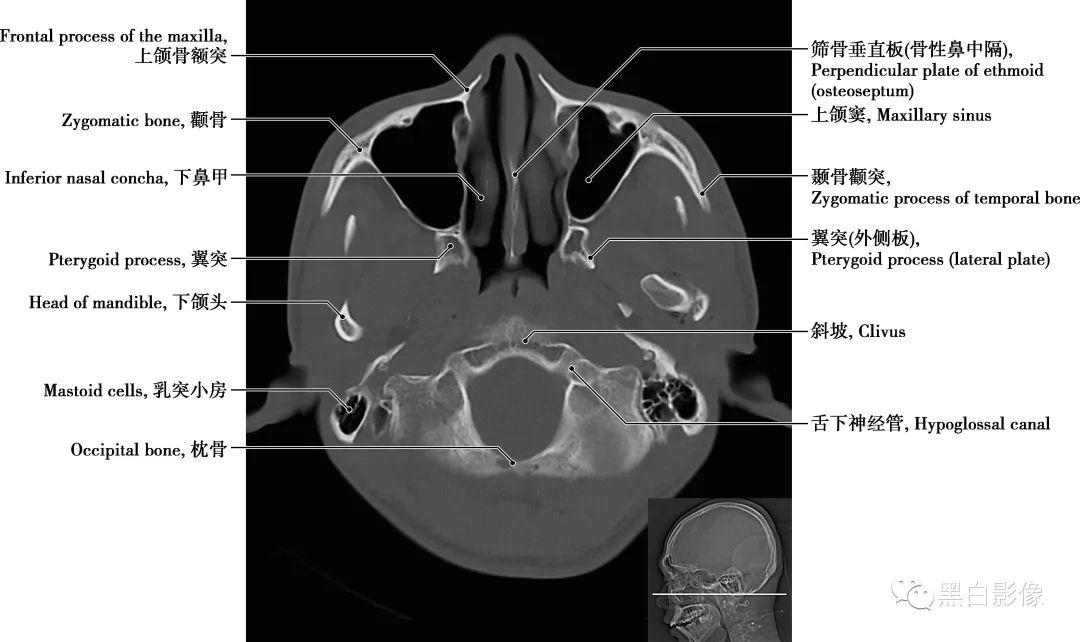 详细标注版!颅脑CT正常解剖图谱 - 知乎