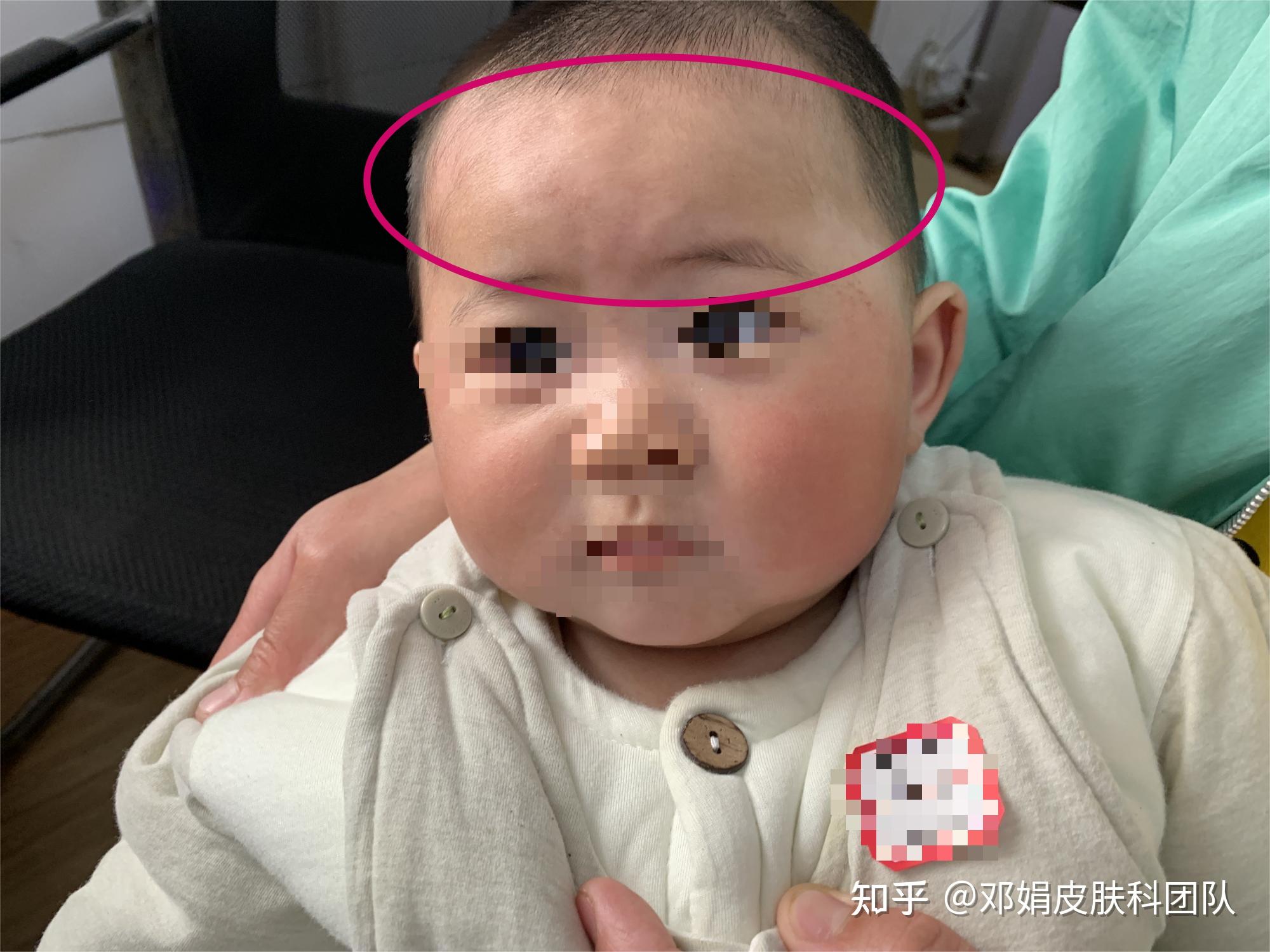 红色胎记与血管瘤的区别！广州肤康胎记科普 - 哔哩哔哩