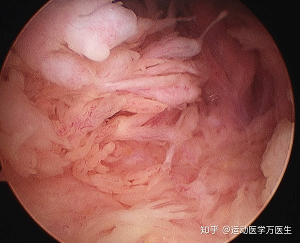 膝关节痛 医生说我得了滑膜炎 该怎么办 知乎