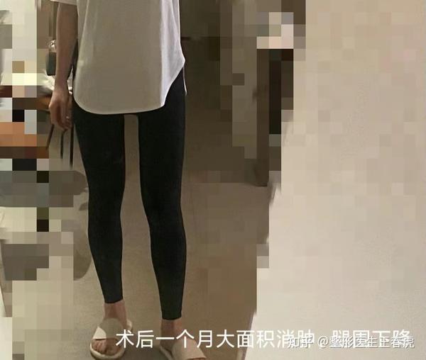 大小腿吸脂术后第四天腿反而变粗了？！ 知乎 3250