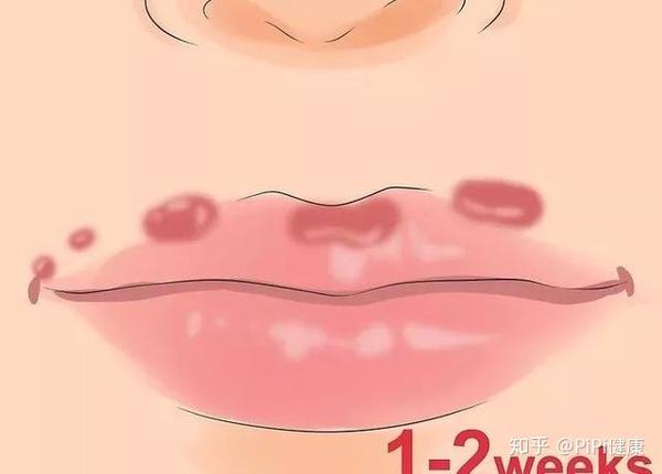 嘴上长泡 暗藏6种致命疾病 做对5件事清火排毒 知乎