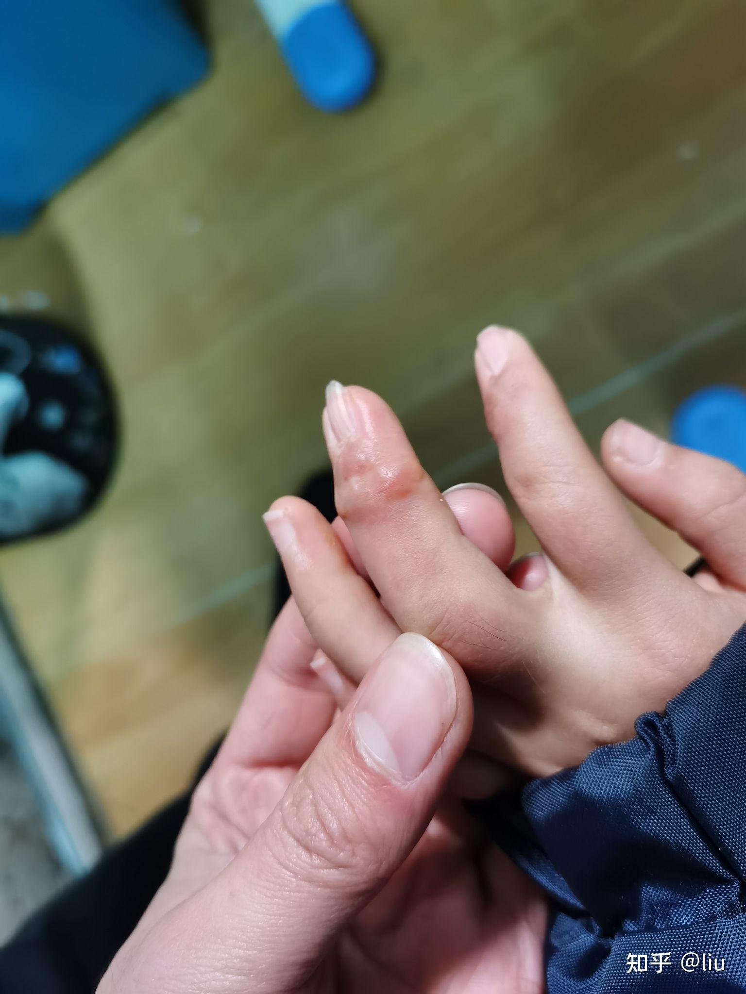 这包涵体纤维瘤 好发于手指跟脚指小朋友手指中指 食指包涵体纤维瘤