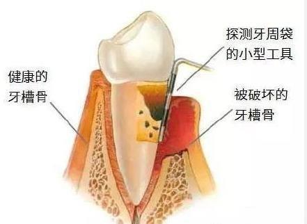 牙周炎導致牙齒脫落的原因