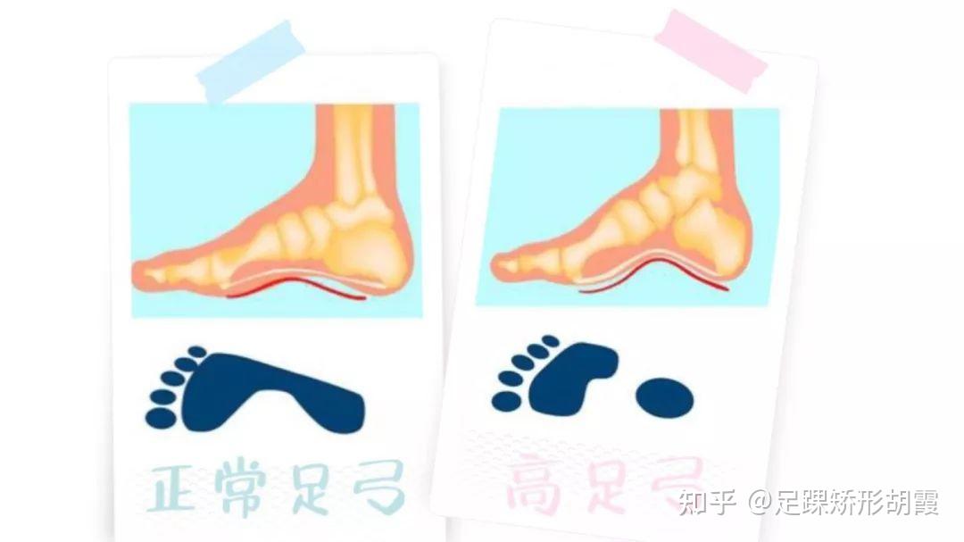 高弓足的朋友该如何挑选鞋子呢？ 知乎 