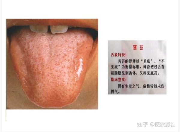 如何通过舌苔来判断身体健康与否?最全舌像来了,一分钟教你学会所有舌像! - 知乎