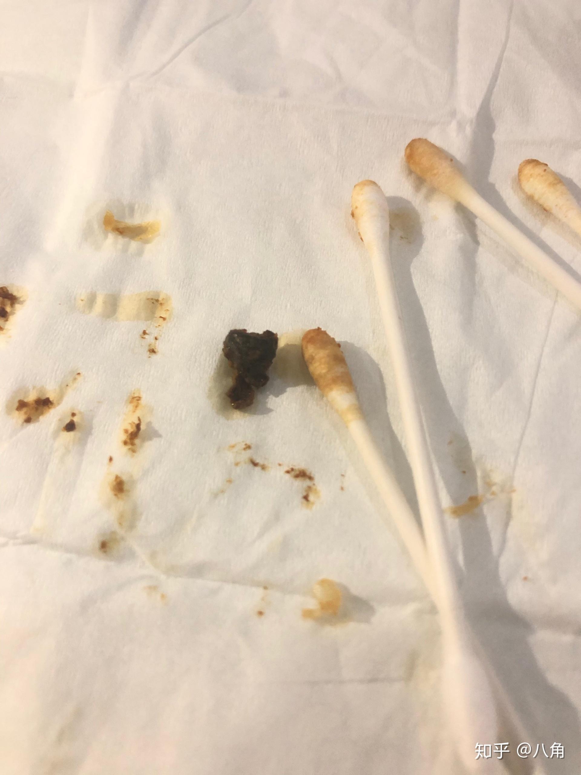 耳屎最大能有多大