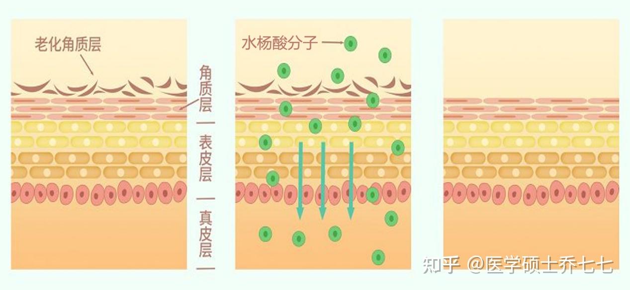 【史上最全刷酸攻略】刷酸真的有用吗?医学硕士手把手教你规范刷酸,解决黑头闭口、粗糙暗沉、毛孔粗大,刷酸新人速速上车!!!