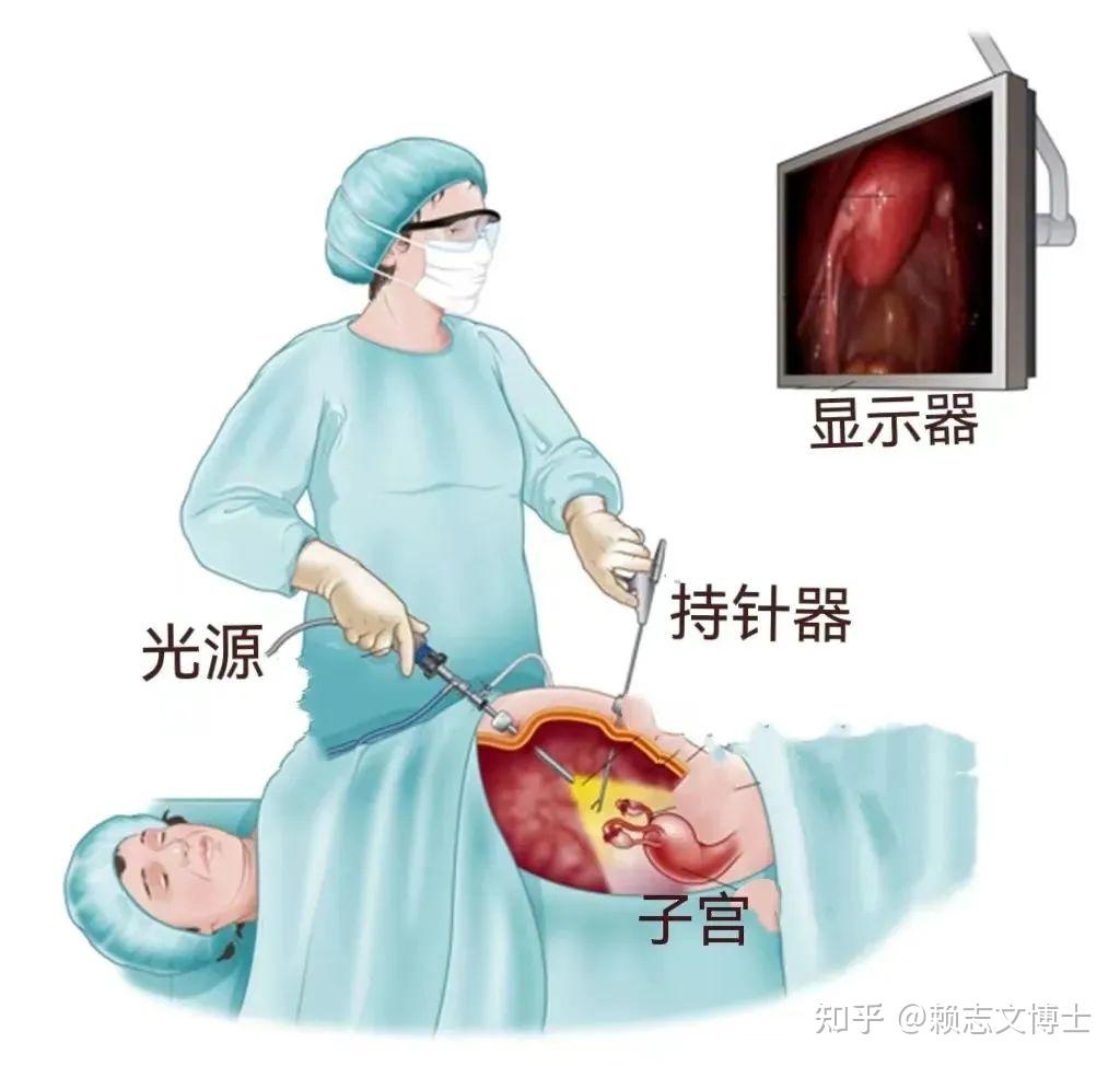 备孕遇上盆腔粘连,赖医生建议这样做! - 知乎