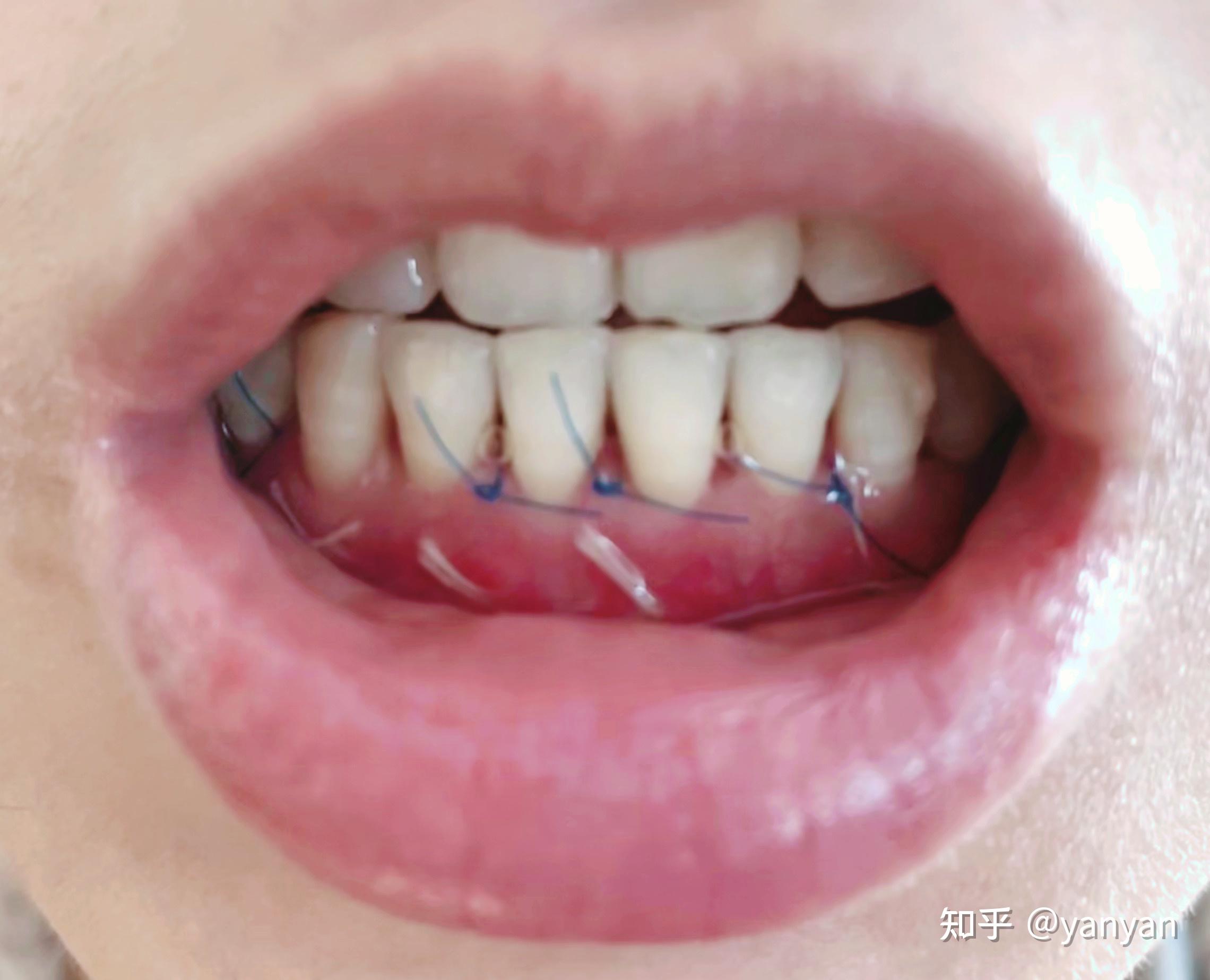 【病例报告】如何使用口内扫描仪在修复治疗中获取清晰的龈下边缘数据 - MEDIT Corp.(美迪特)