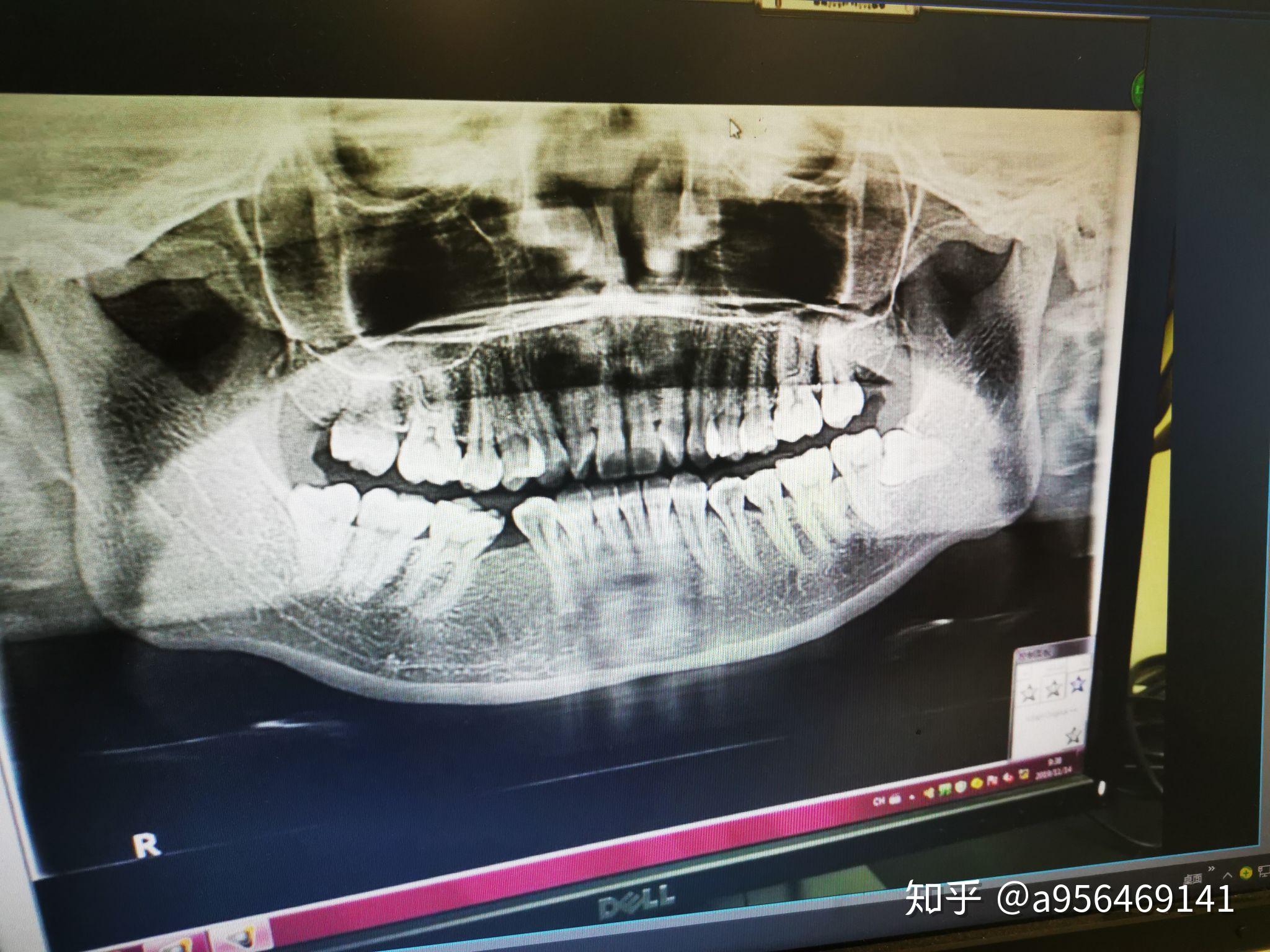 记录一下我的舌侧矫形