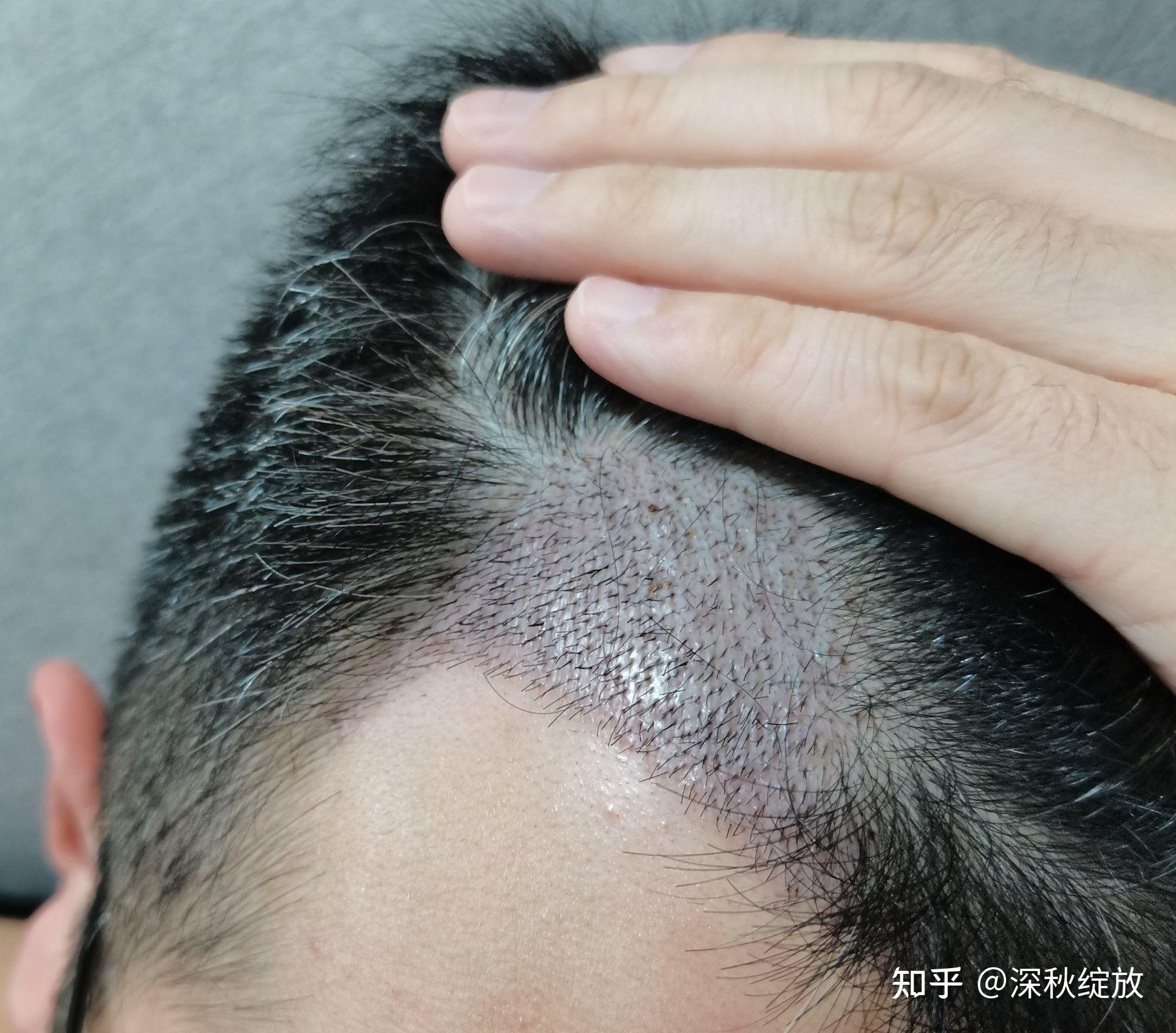 1400单位毛囊植发记录额角区域