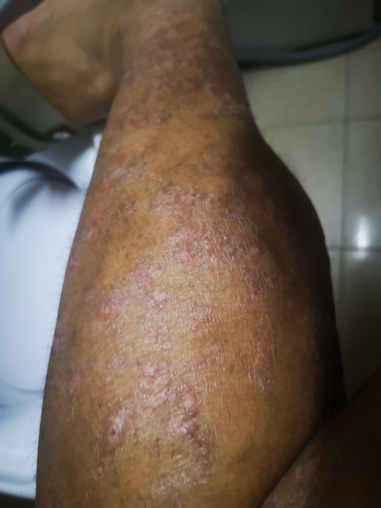 20年老牛皮癣接受可善挺治疗记录