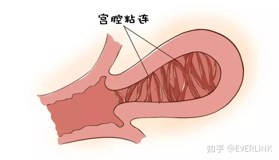 子宮的內部就像一個氣球,其前壁和後壁彼此相對.