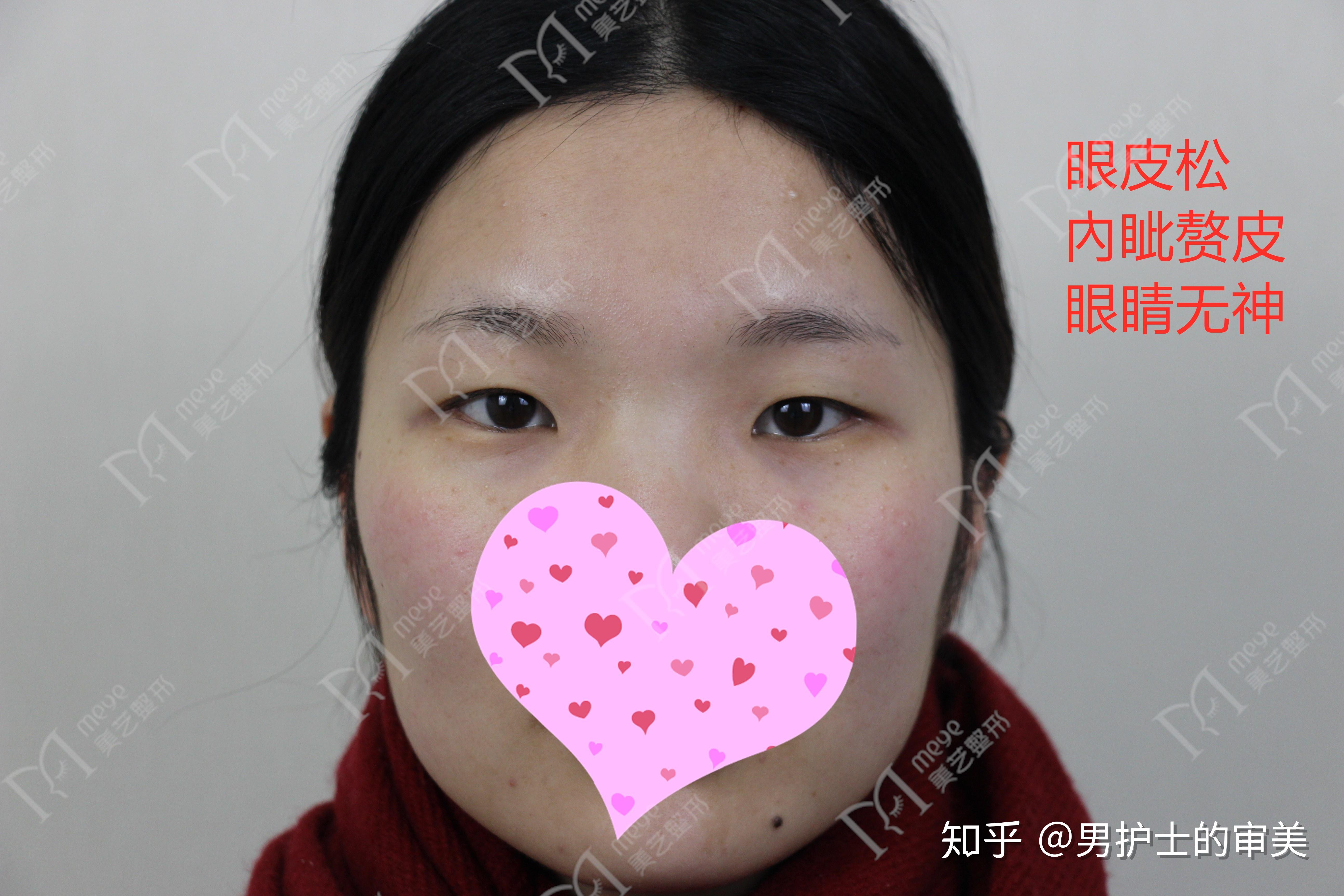 全切双眼皮开眼角术后有人说双眼皮太窄了,你觉得呢?