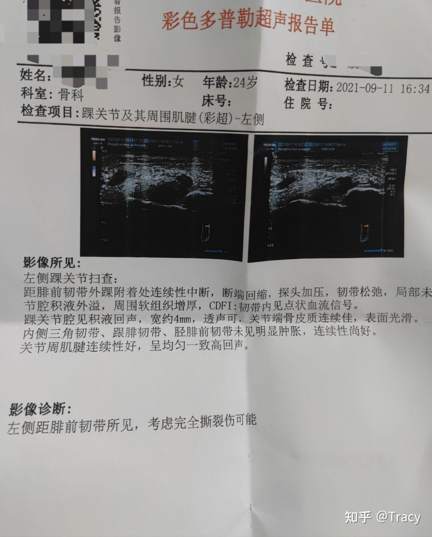 前距腓韧带完全撕裂到康复的过程