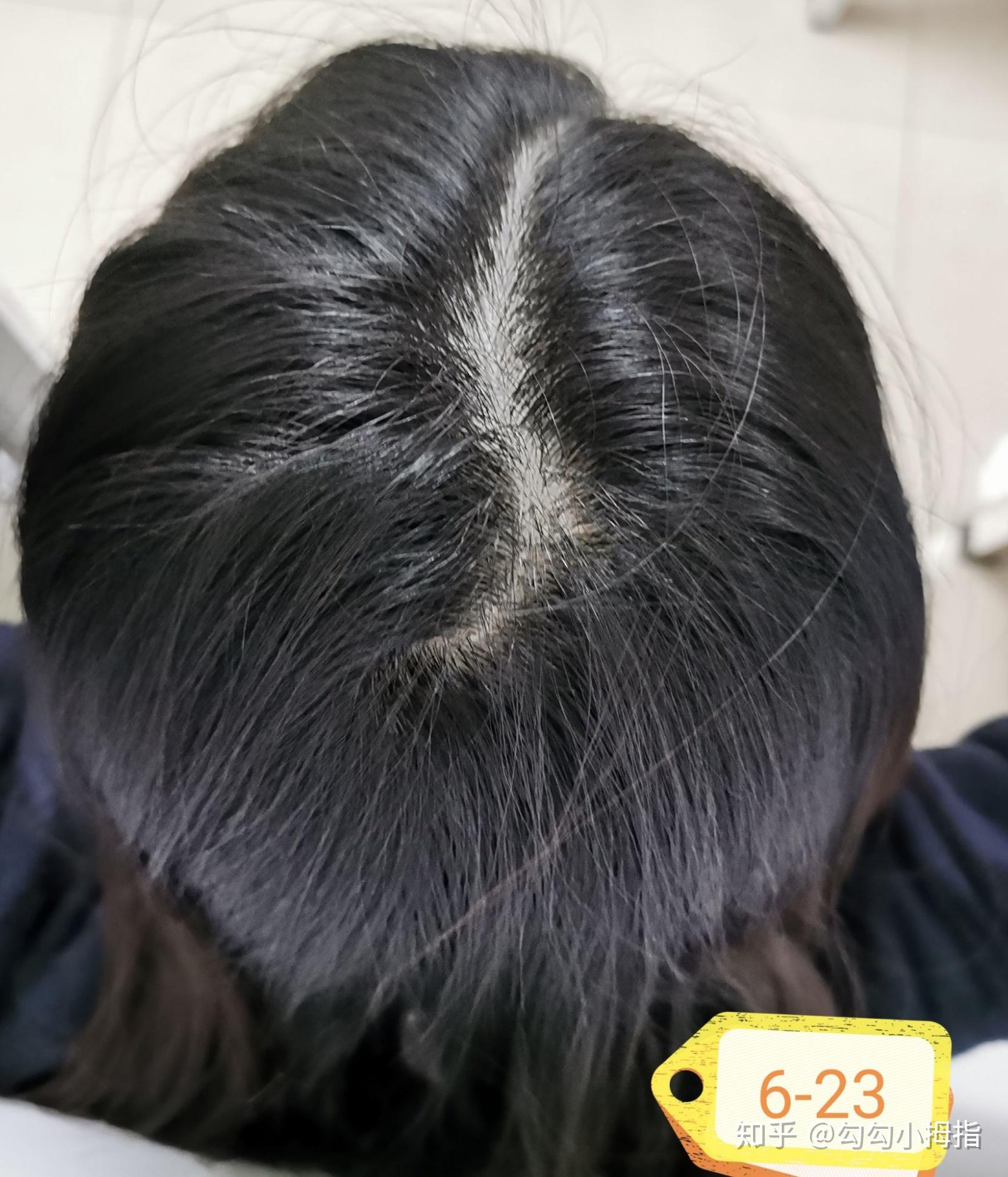 脂溢性脱发的生发之路