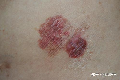 日常科普 常见的皮肤癌有哪些 知乎