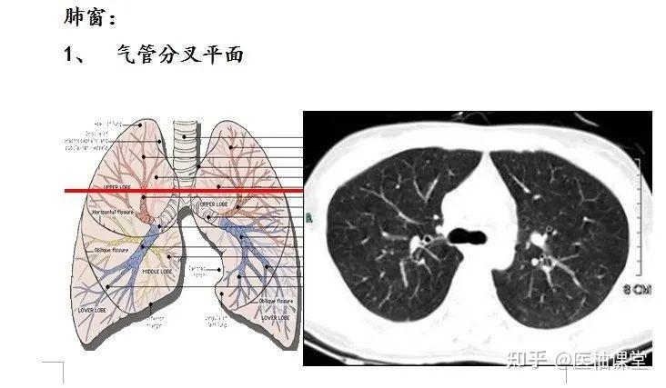 ct肺段定位口诀图文结合异常清晰