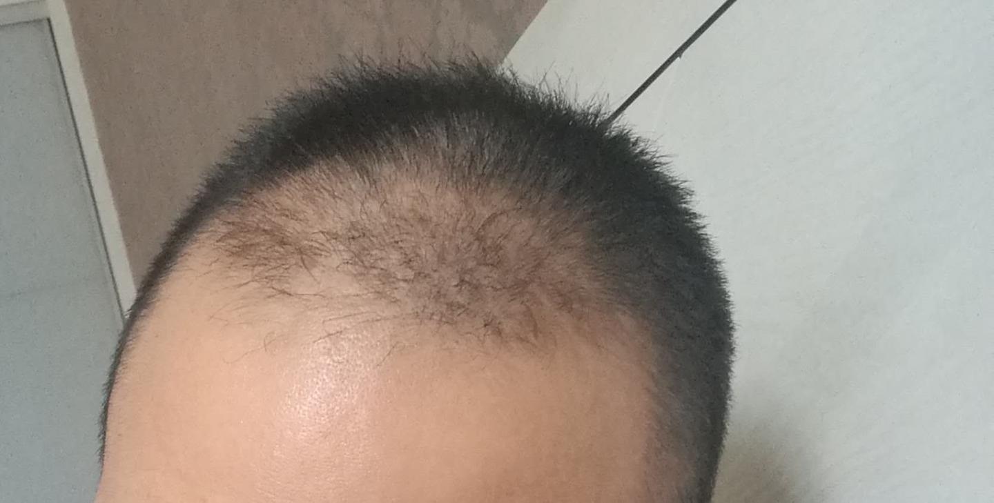 给脱发想植发还在犹豫的人参考 知乎