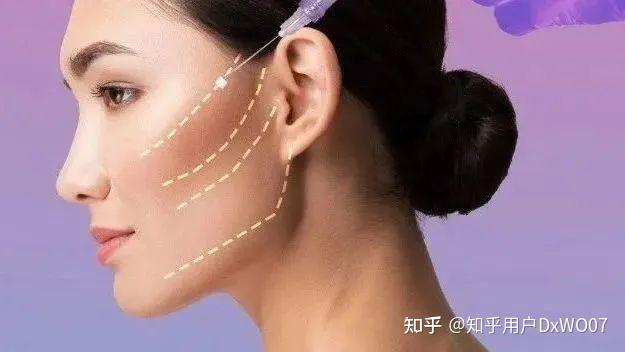 欧益医疗 | 代理的法国「春天带」Spring Thread®「面部埋植线」正式获批 - 知乎