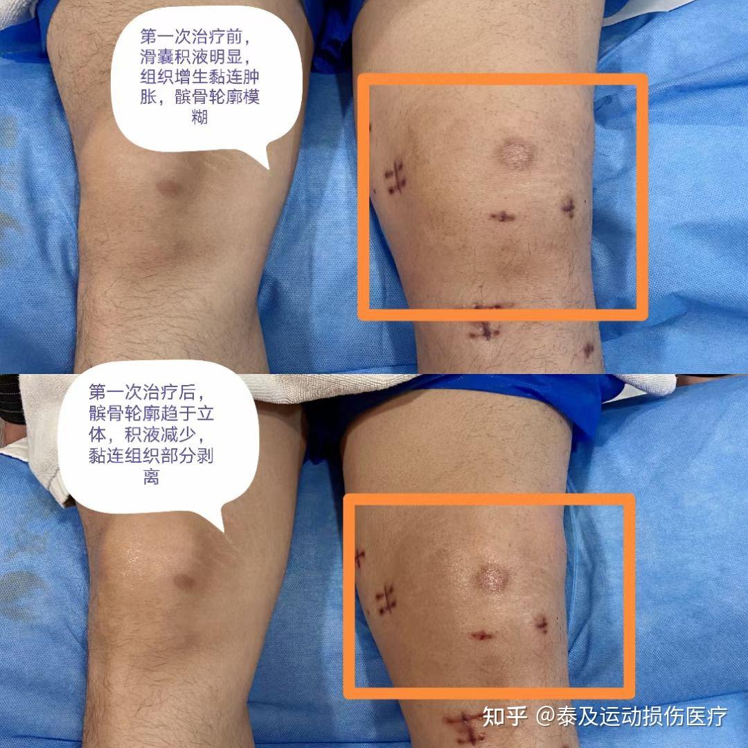 积液到底有多坏三