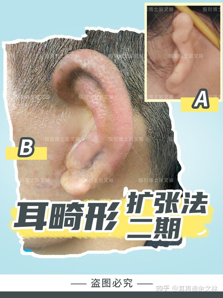 耳廓结构清晰,对耳轮等结构明显,三角窝,耳舟,耳甲腔深度,广度适中