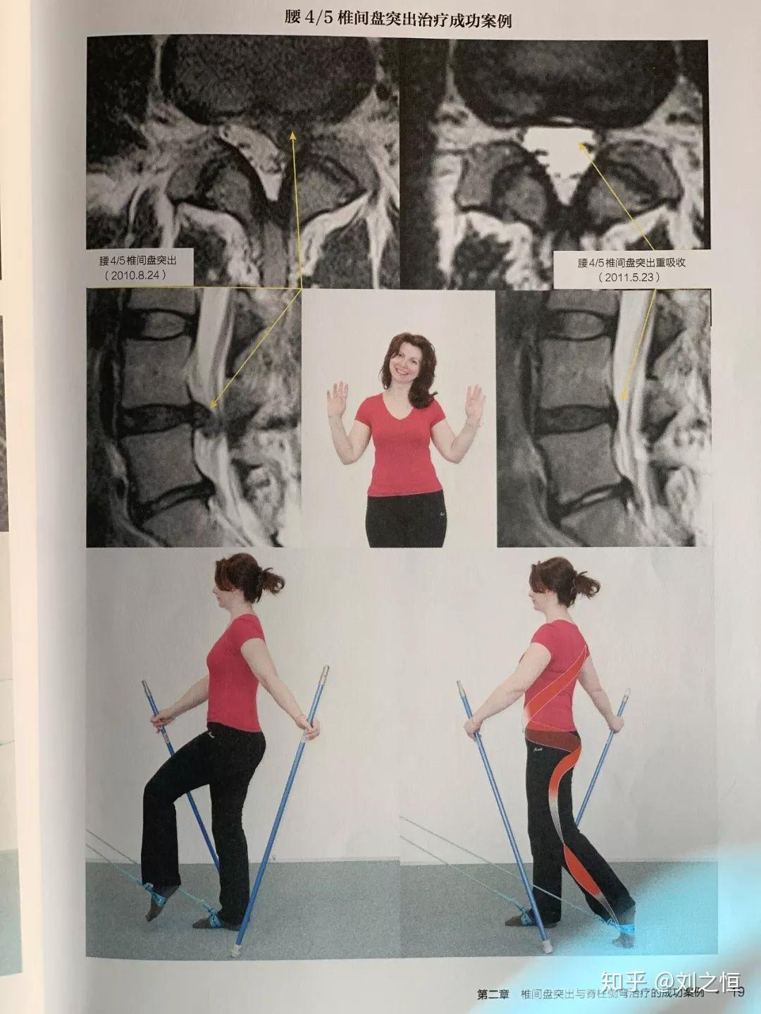 腰椎间盘突出脊柱侧弯根源性恢复系统sps肌肉螺旋链