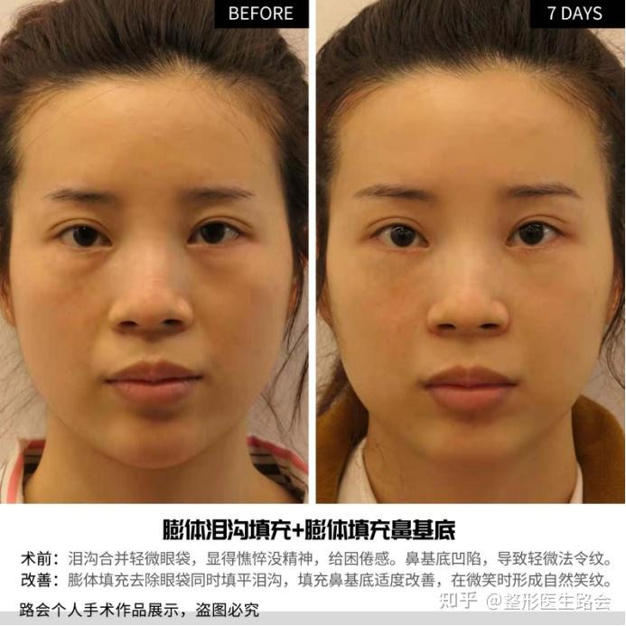 术后7天效果对比