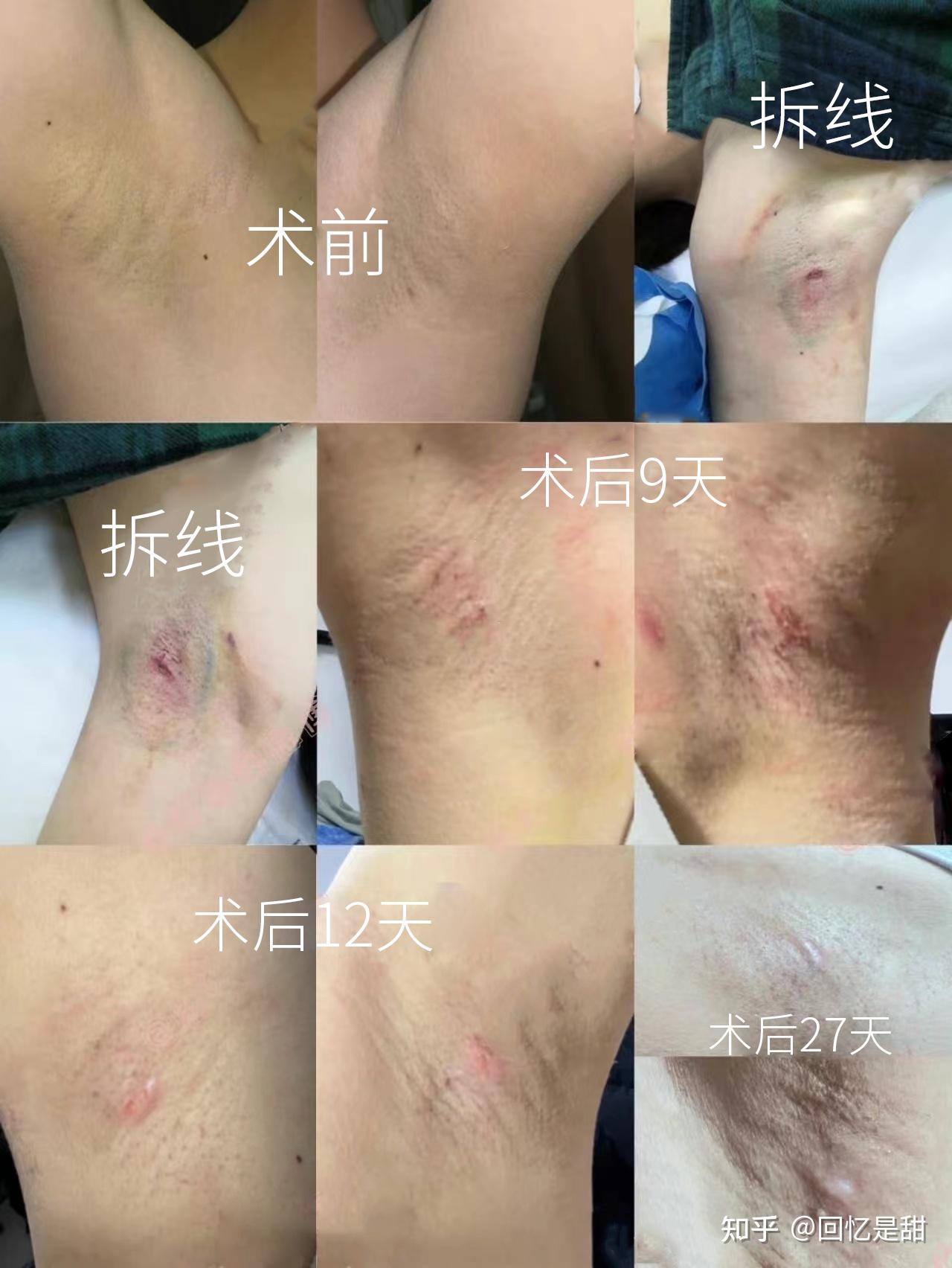 郑州公立医院做的狐臭手术,腋下恢复全记录,仅供参考! 