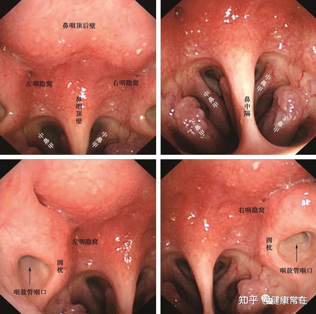 鼻咽顶后壁隆起图片