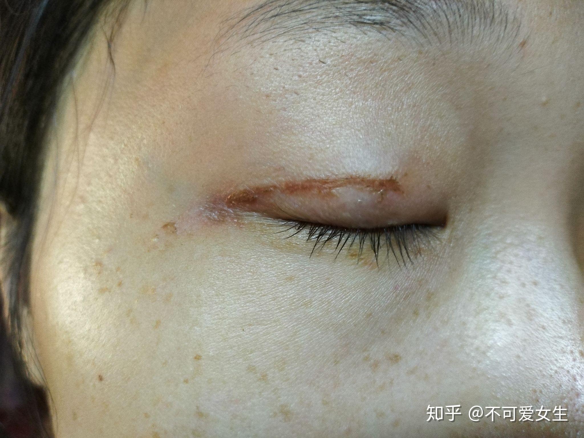脸上的疤痕如何祛除_凤凰网视频_凤凰网