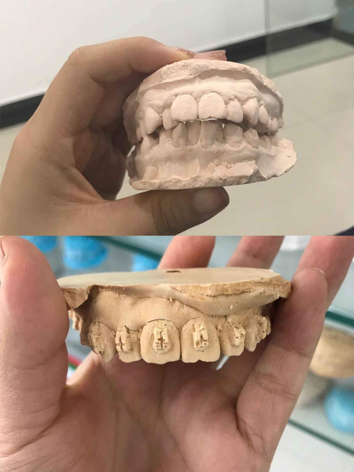 三个月上牙牙模的对比02变化还是很大的