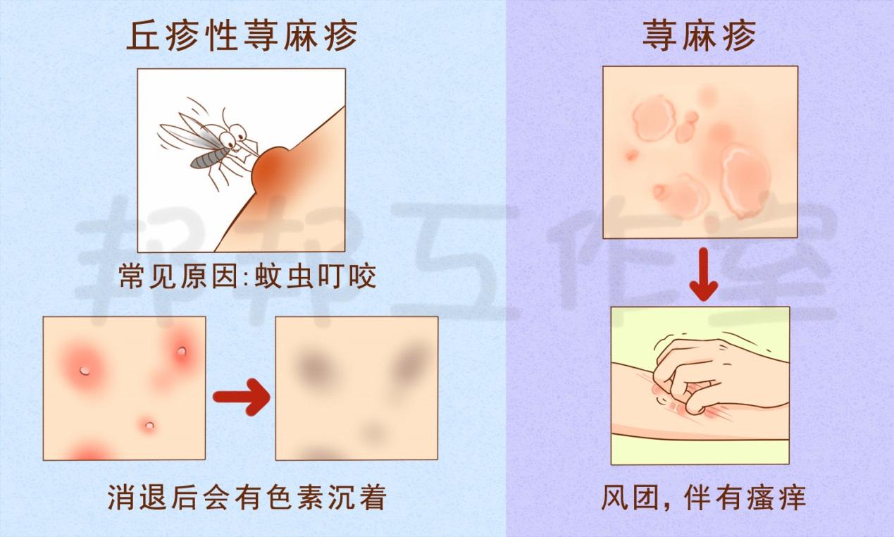 麻疹特点图片