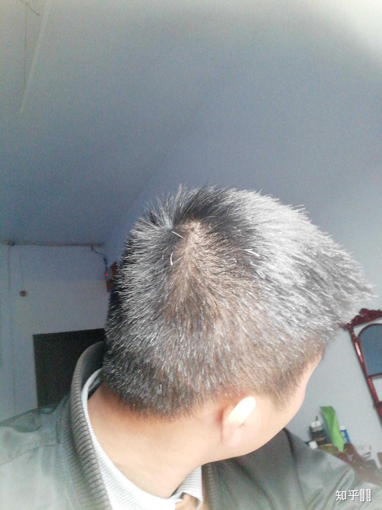 有少白头是怎样一种经历