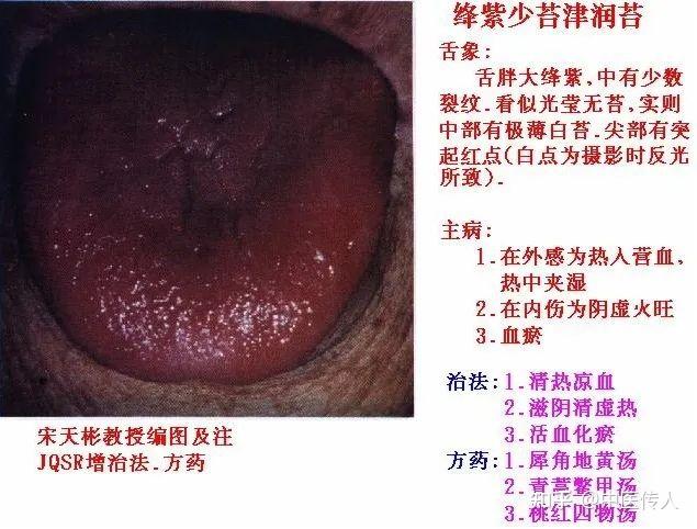 高清舌诊图解:各种临床证型舌象图谱大开眼界 - 知乎