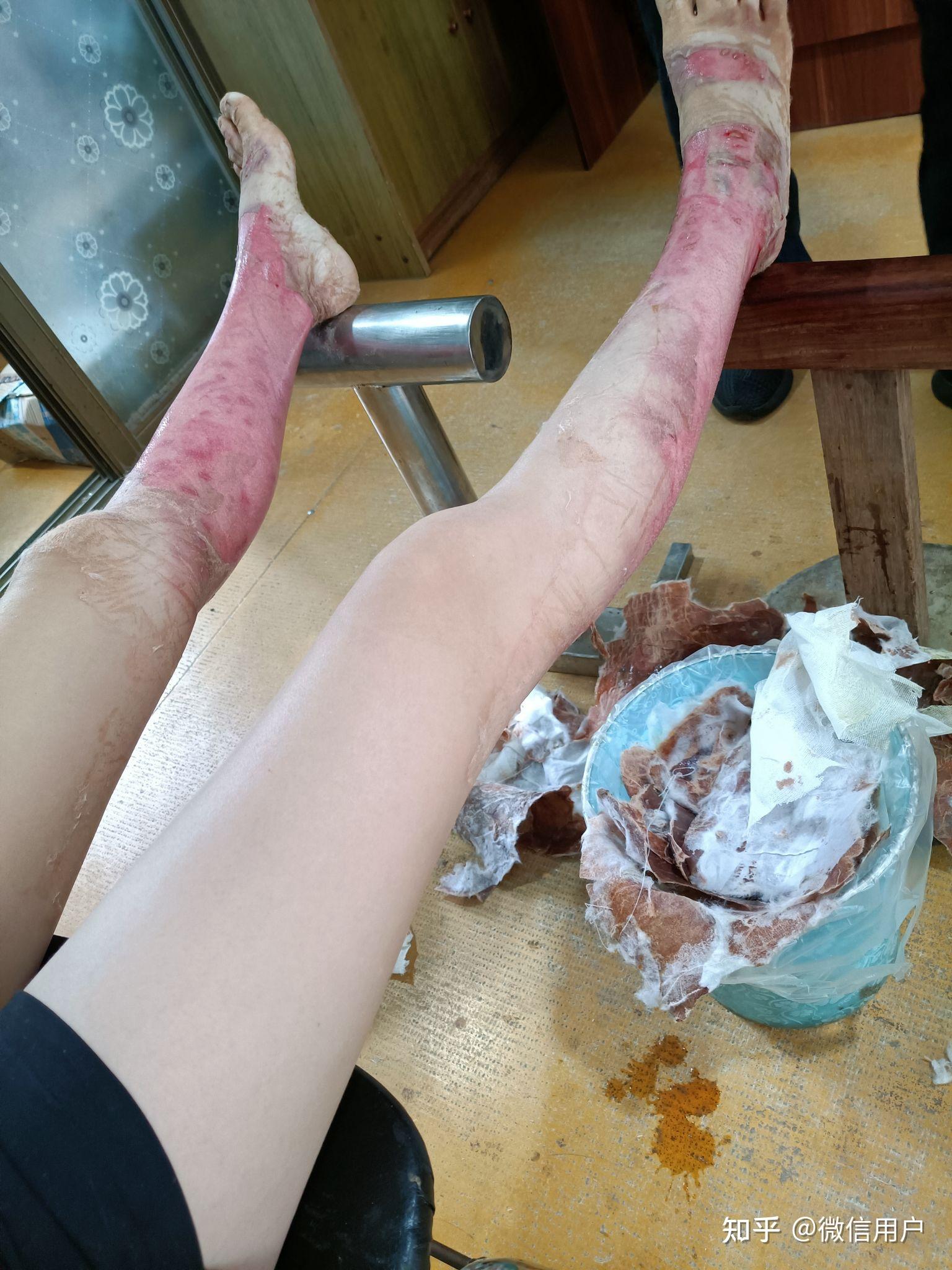 记录烧伤恢复过程图片高能注意查看