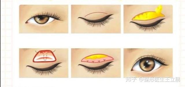 将皮肤肌肉和睑板连接在一起,使皮肤凹进去形成一道褶皱,就是双眼皮