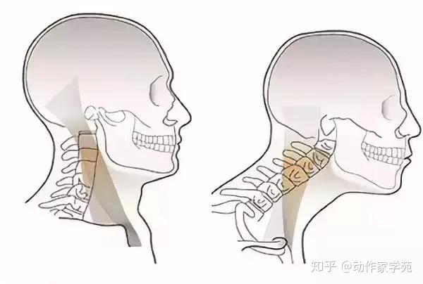 不論我們仰頭,低頭或者側屈,我們的胸鎖乳突肌都是處於縮短的狀態,而