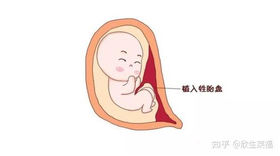 前置胎盘有4种一张图带你秒懂