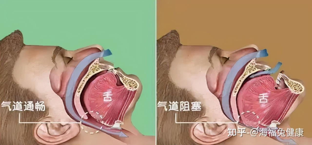 生活当中最快治疗打鼾的方法都有哪些