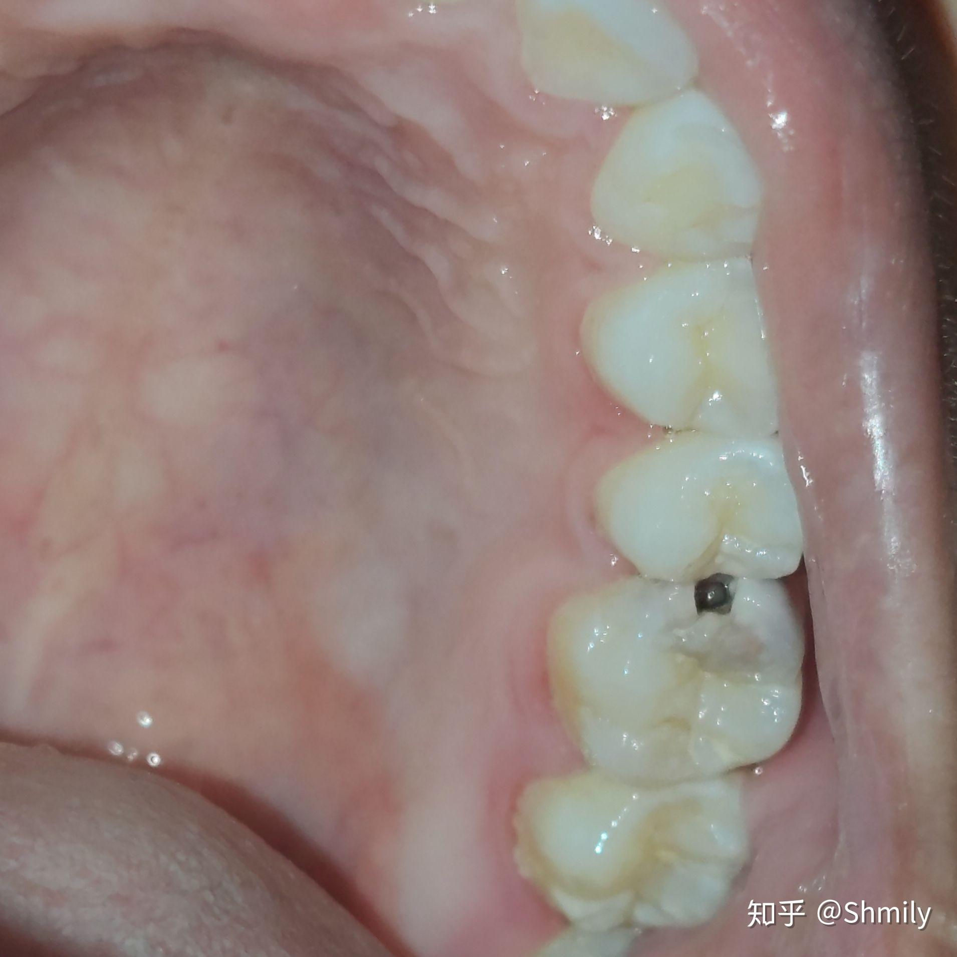 我的牙这几天都没疼 不过我已经联系了医生 医生说一定要及时看 蛀牙