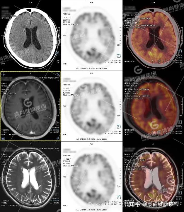 PET/CT-MR 多模态融合技术在临床中的应用病例分享（一） - 知乎