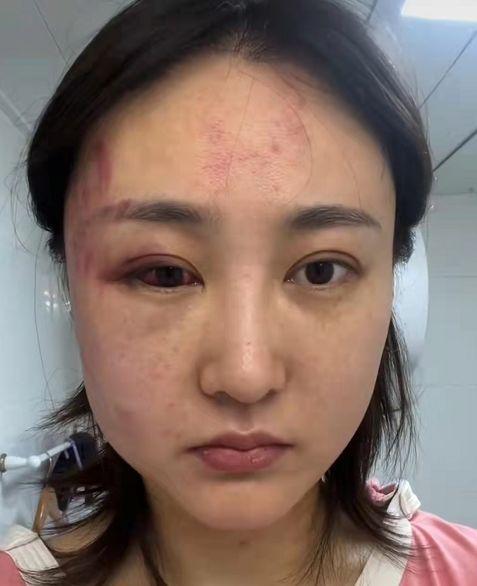 一半的脸都肿了,太阳穴位置周边充满了红痕和淤血