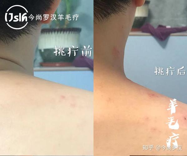 挑羊毛疔调理肩周炎