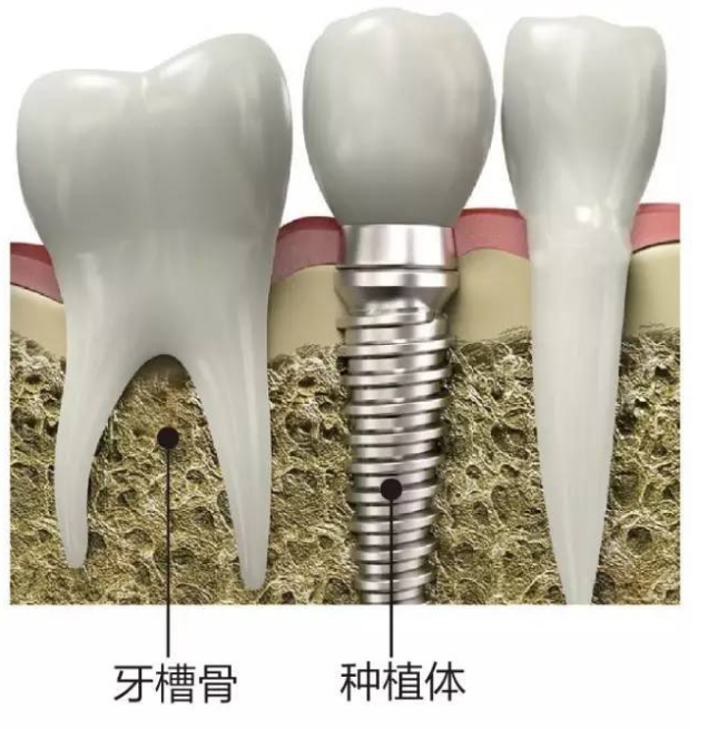 朱医生种植牙图片